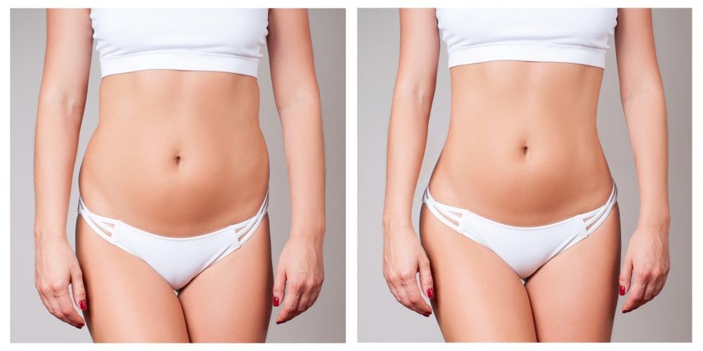 Tummy Tuck vs. Liposuction in Cancun: Which is Right for You?
