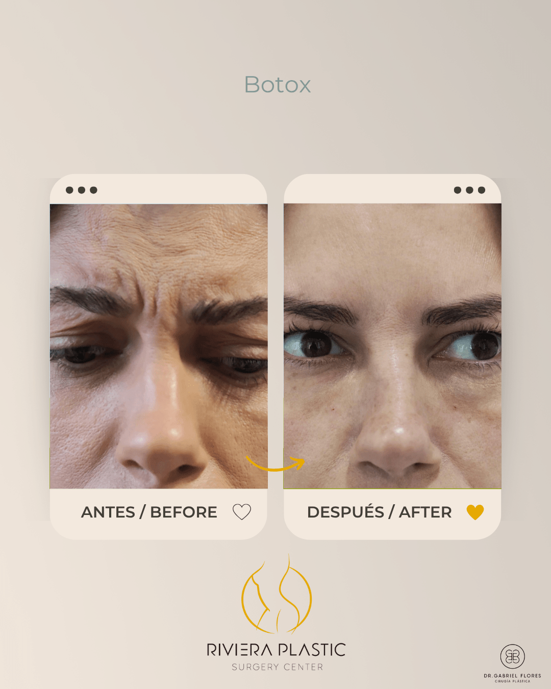 Cancun botox