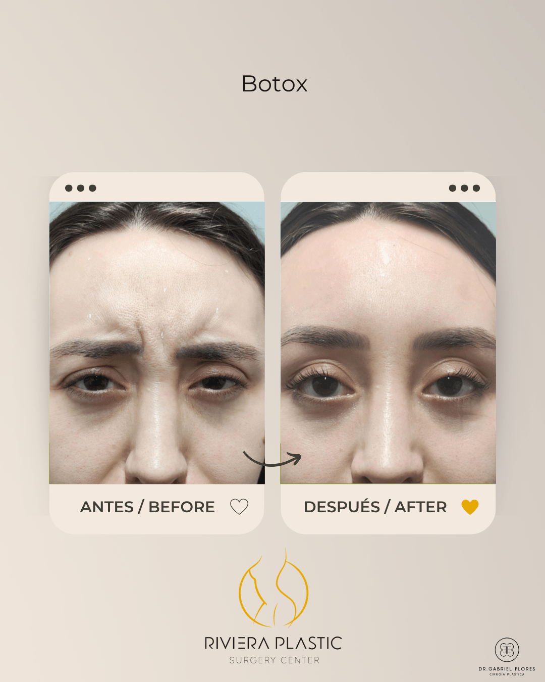 Cancun botox