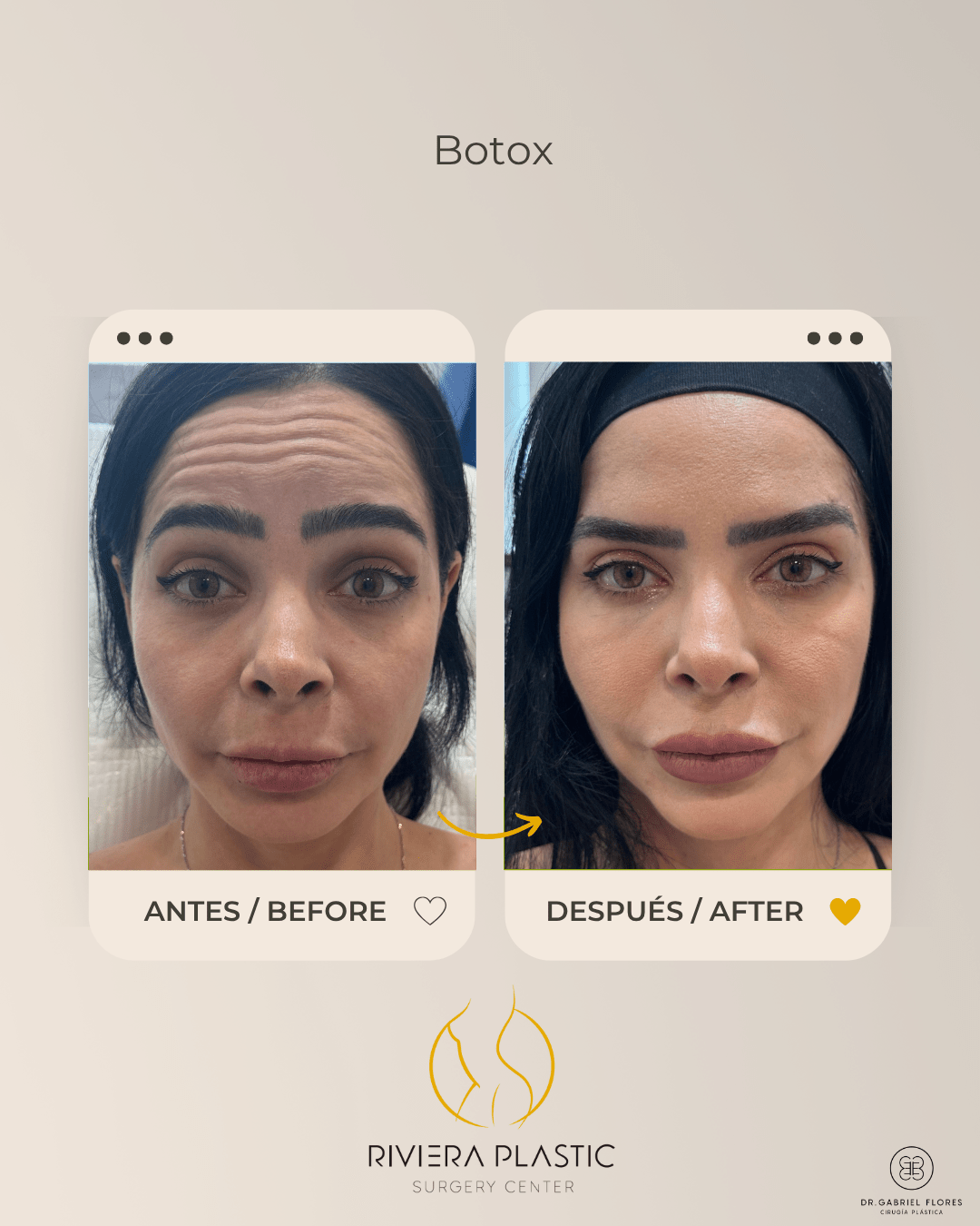 Cancun botox