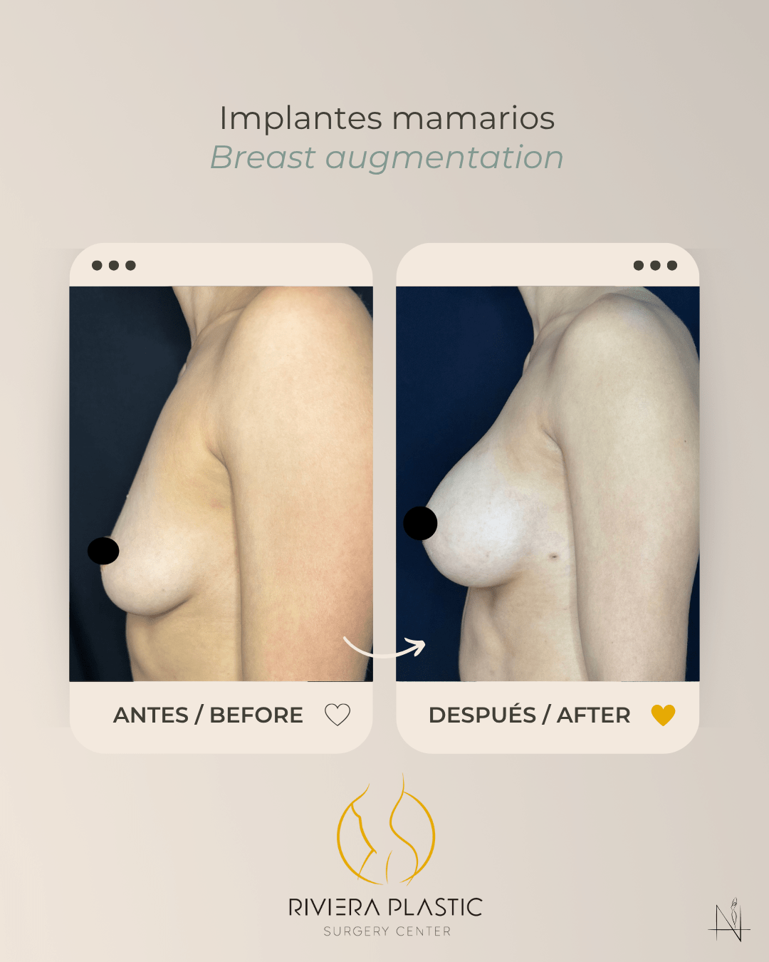 breast implants in cancun