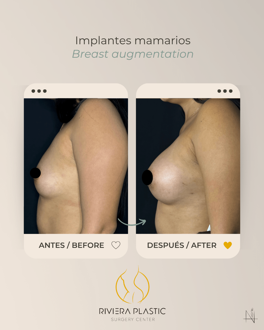 breast implants in cancun