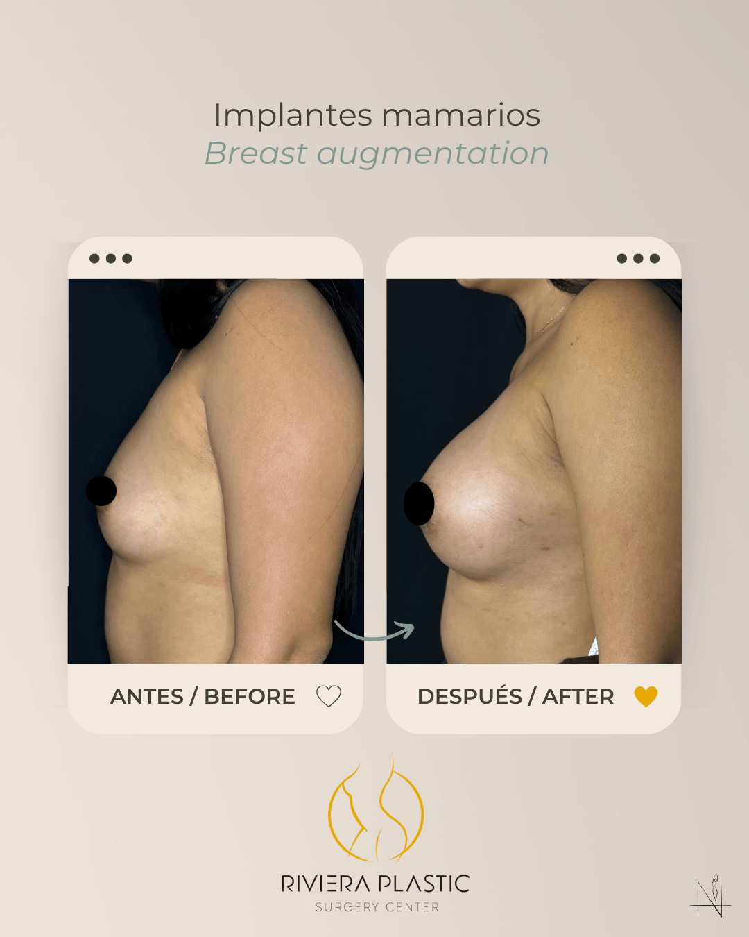 breast implants in cancun