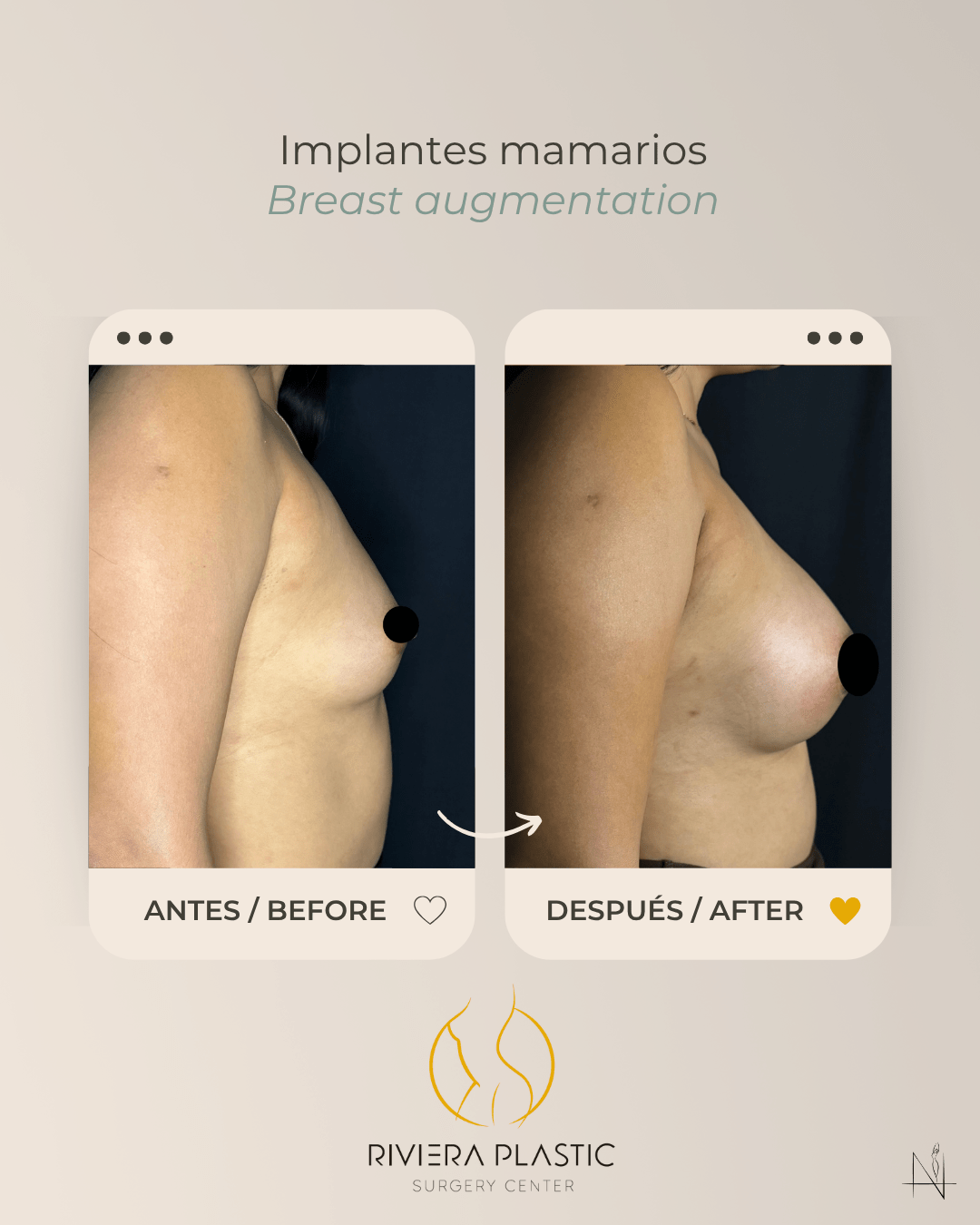 breast implants in cancun