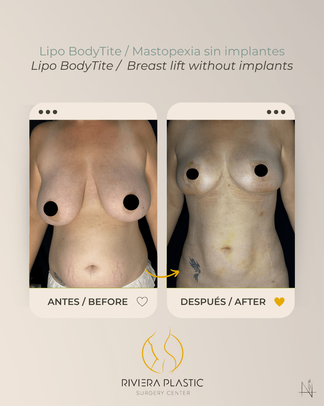 lipo body tite and breast lift without implants in cancun
