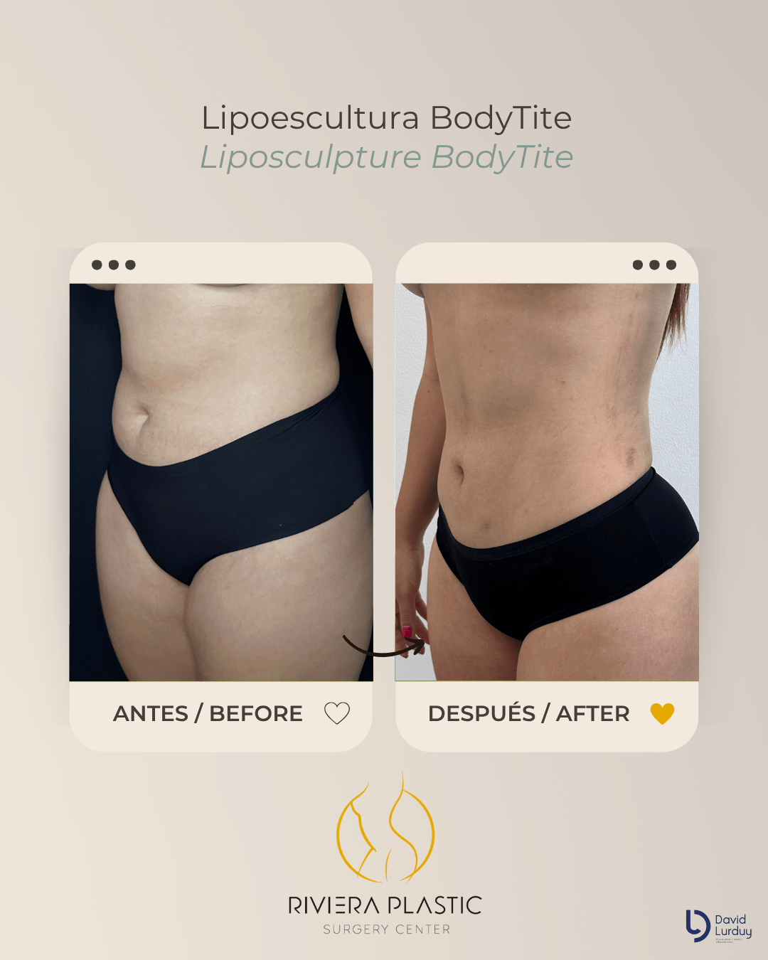 Lipo BT Lurduy 1a