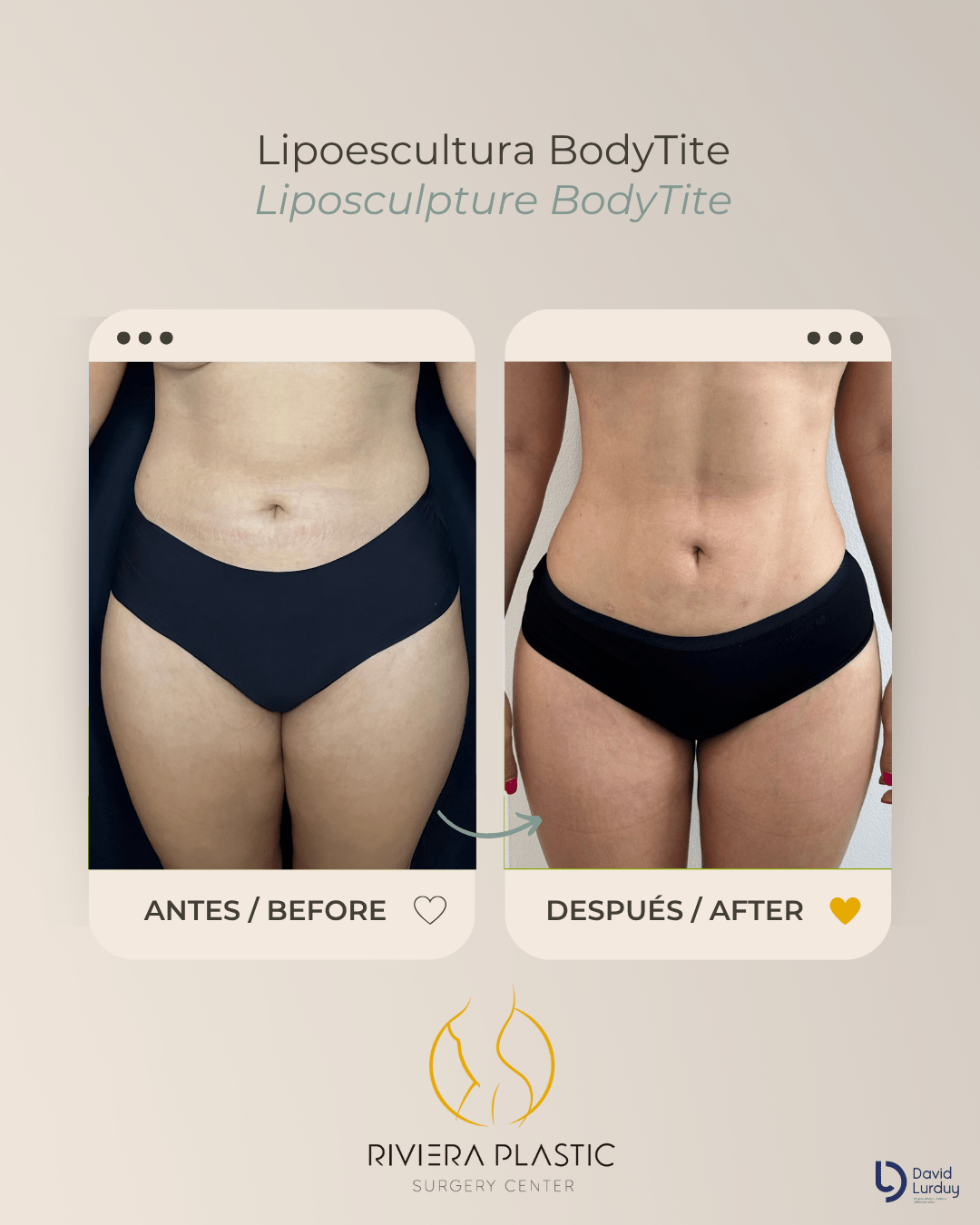 Lipo BT Lurduy 1b