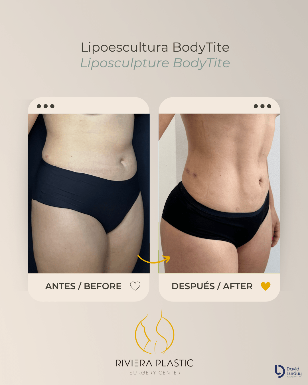 liposculpture bodytite in cancun