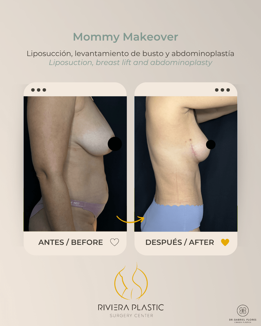 cancun mommy makeover